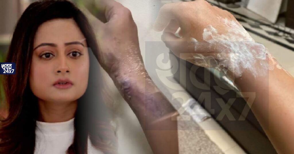 শুটিং করতে গিয়ে হাত পুড়ে বড় বড় ফোসকা পড়ল মিঠাই খ্যাত তোর্সার! 'কফি করতে গিয়ে নাকি অন্য কিছু বৌদিমণি?', তন্বীকে প্রশ্ন নেটিজেনদের