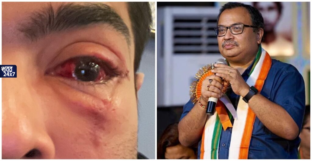 আমেরিকার হাসপাতালে চোখের অস্ত্রোপচার অভিষেকের, তৃণমূল সাংসদের চোখের ছবি পোস্ট করে নিন্দুকদের একহাত নিলেন কুণাল আমেরিকার হাসপাতালে চোখের অস্ত্রোপচার অভিষেকের, তৃণমূল সাংসদের চোখের ছবি পোস্ট করে নিন্দুকদের একহাত নিলেন কুণাল