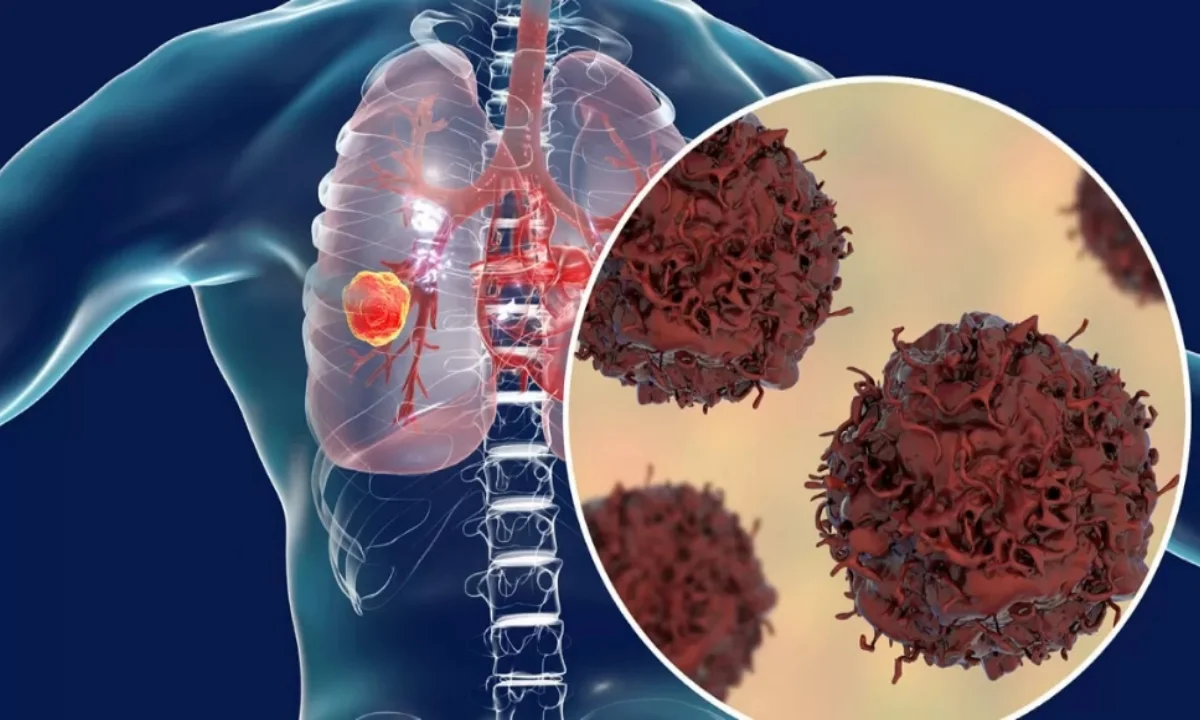 বায়ু দূষণ, ক্যান্সার, air pollution, cancer, Lung cancer